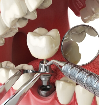 dental-implant