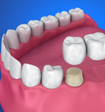 generic-dental-implant
