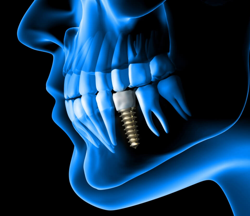 dental-implant-solutions