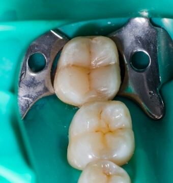 dental-restorations-and-fillings