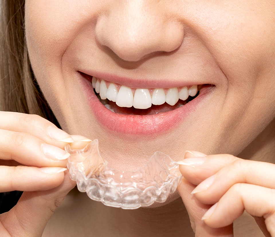 invisalign-4