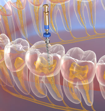 root-canal-treatment-1