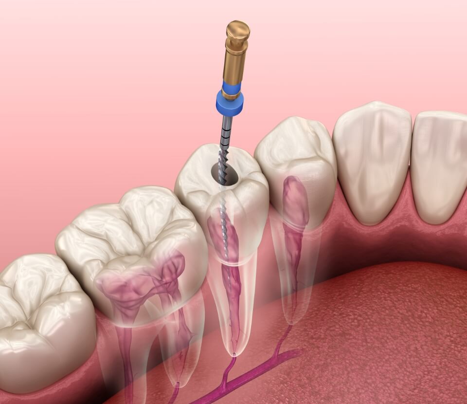 root-canal-treatment-concord