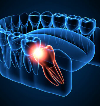 tooth-extraction-and-wisdom-teeth-1