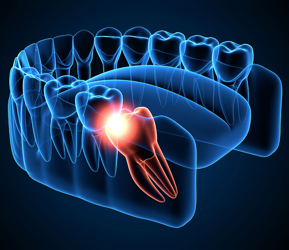 tooth-extraction-and-wisdom-teeth-1