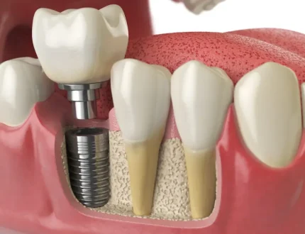 64ffd18eb59674f0a7f81e65_dental-implants-1-920x690.jpg